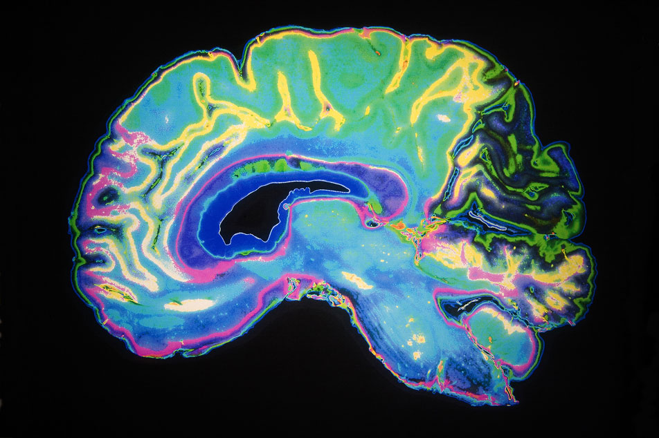 brain scan showing multi-colors